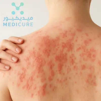 A Eczema & Psoriasis In Dubai showcases a striking close-up, where red, itchy spots on the skin stand out against a stark white background. The image, taken in Dubai, captures a unique visual experience, highlighting the conditions prominence.