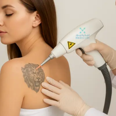 A Laser Tattoo Removal Dubai showcases a womans journey, with a professional device in her hand. The white wand, connected to the removal system, skillfully eradicates a lion tattoo on her shoulder. This Dubai clinics attention to detail and precision are on full display.
